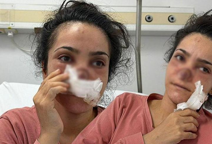 Eşi tarafından burnu ısırılıp koparılan kadın konuştu: Acıyla balkondan atlamayı bile düşündüm